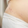 7 vấn đề da thường gặp khi mang thai mẹ cần chú ý